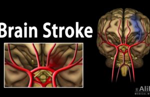 ब्रेन स्ट्रोक का शिकार हुआ भारत का हर तीसरा व्यक्ति